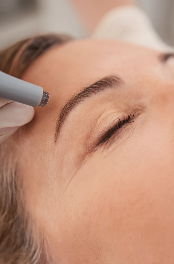 What Is Microneedling? Banner