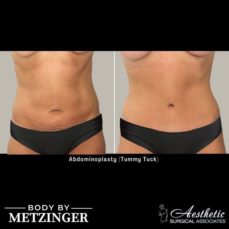 Before and After Gallery: Tummy Tuck