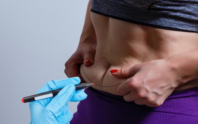 Is Tummy Tuck Worth It Compared to Non-Surgical Options? banner